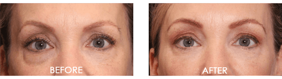 Facial Skin Tightening Case 1 Image