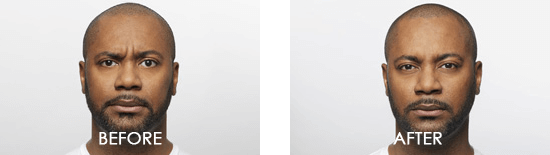 Dysport Case 1 combined Image