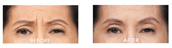 Botox Case 2 combined Image