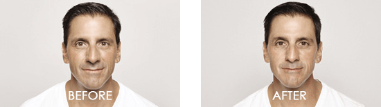Dysport Case 4 combined Image