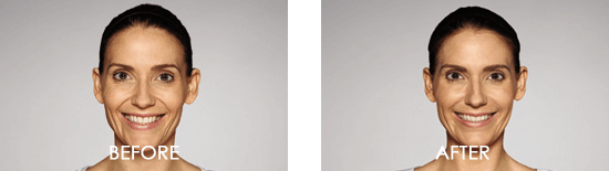 Dysport Case 3 combined Image