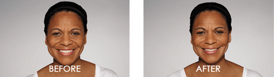 Dysport Case 2 combined Image