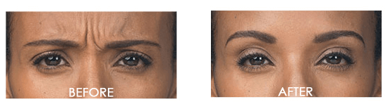 Botox Case 8 combined Image