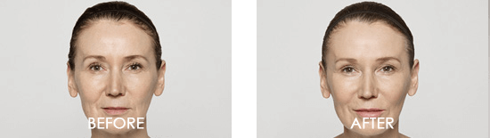 Dysport Case 10 combined Image