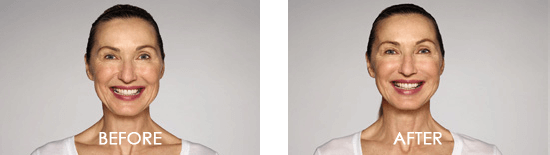 Dysport Case 9 combined Image