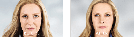 Dysport Case 7 combined Image