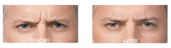Botox Case 6 combined Image