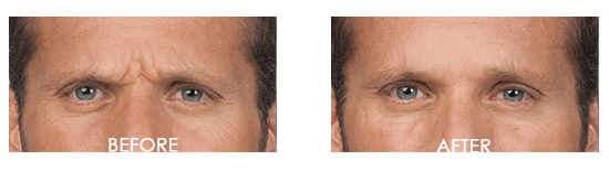 Botox Case 5 combined Image