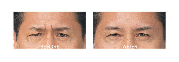 Botox Case 4 combined Image