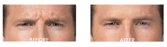Botox Case 3 combined Image