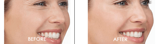 Botox Case 1 combined Image