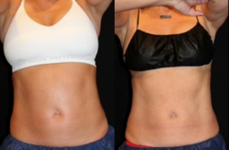 Medical Weight Loss Case 1 combined Image
