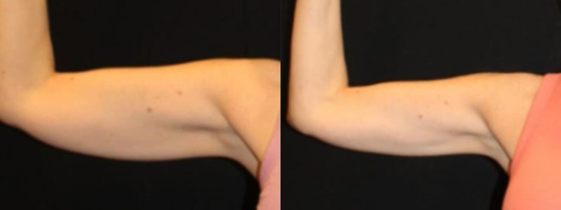 Coolsculpting Case 14 combined Image