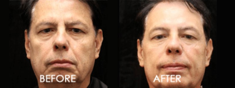 Exilis Ultra Case 1 combined Image