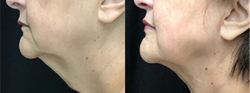 FaceTite, BodyTite & AccuTite by Inmode Case 5 Image
