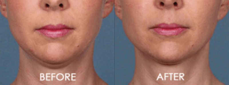Kybella Chin Contouring Case 2 combined Image