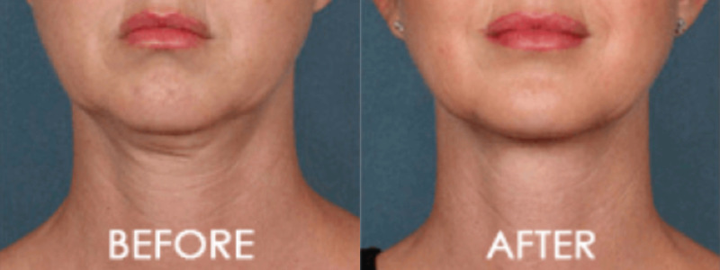Kybella Chin Contouring Case 4 Image