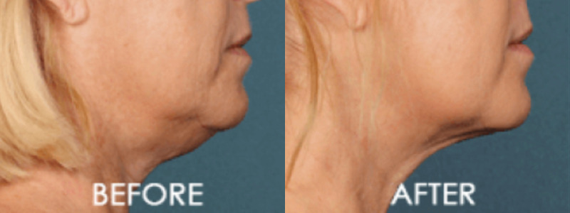 Kybella Chin Contouring Case 5 combined Image