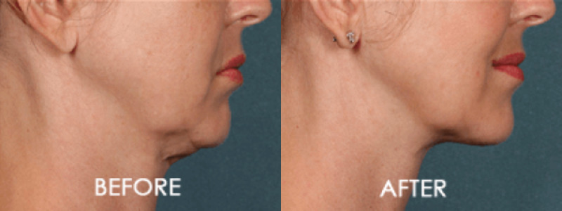 Kybella Chin Contouring Case 6 Image