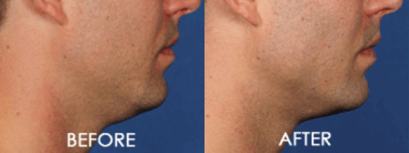 Kybella Chin Contouring Case 7 combined Image