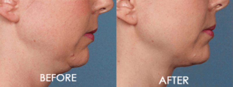 Kybella Chin Contouring Case 8 Image