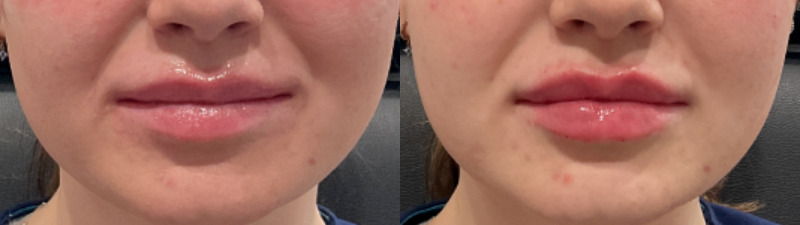 Restylane Kysse Case 1 Image