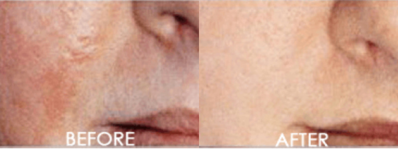 Skin Micro-Dermabrasion or Exfoliation Case 2 combined Image