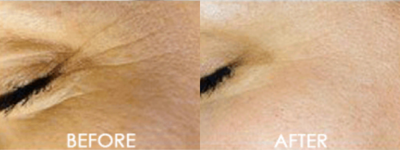 Skin Micro-Dermabrasion or Exfoliation Case 1 combined Image