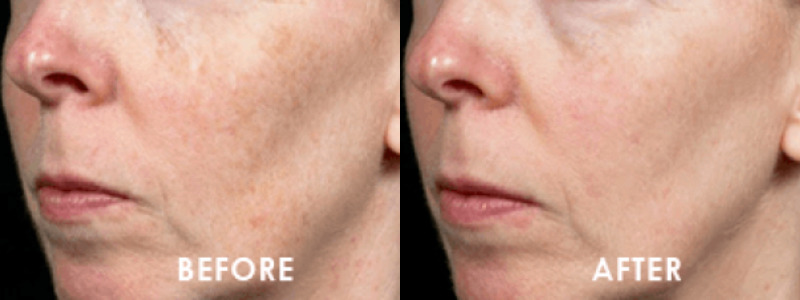 ThermageFLX Skin Tightening Case 2 combined Image