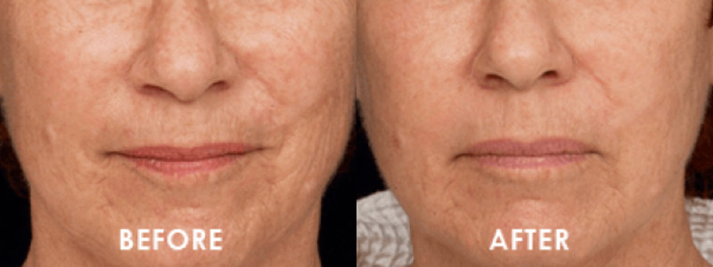 ThermageFLX Skin Tightening Case 1 combined Image