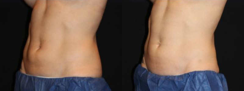 Coolsculpting Case 18 Image