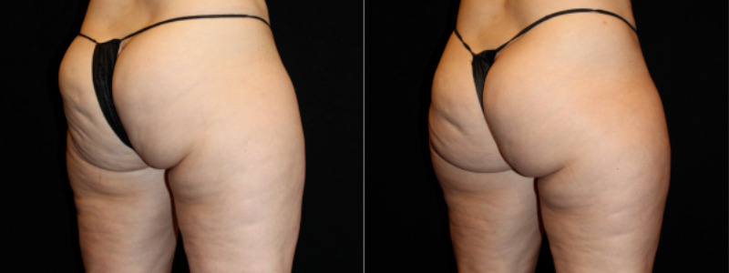Muscle Stimulation Case 1 Image