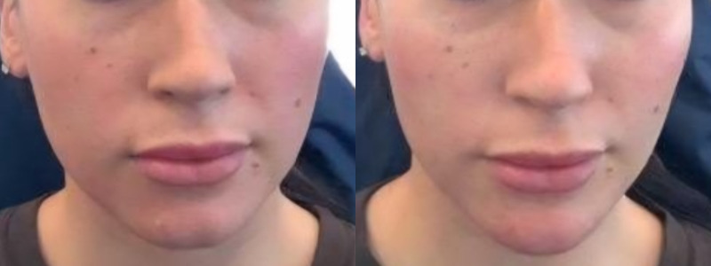 Voluma Case 1 Image