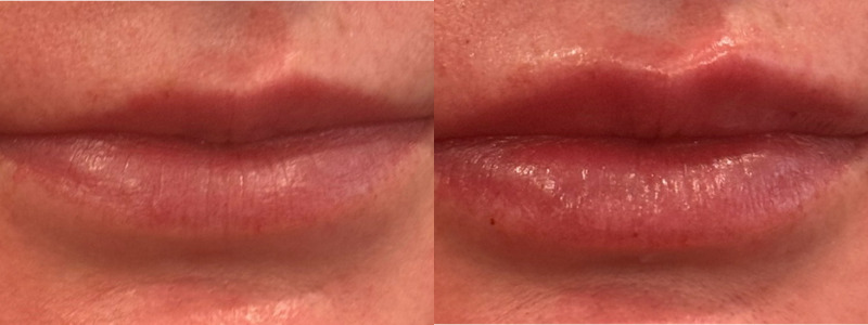 Volbella Case 9 Image